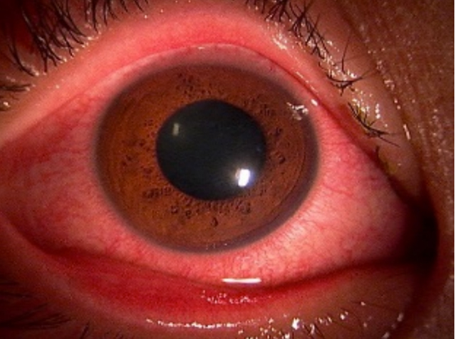P6 3 日本眼科医会資料より「ウイルス結膜炎」 - 「目に見えない被害」<br>水害の後片づけ
